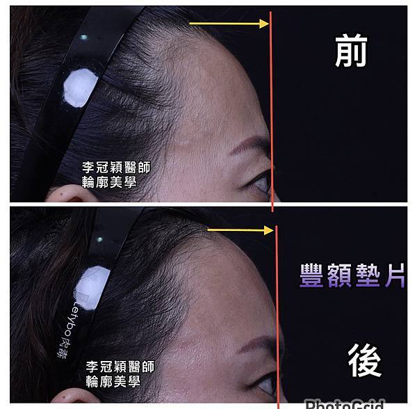 墊額頭『順便』拉頭皮但是留下大疤痕... 難接受😔😔😔。如果