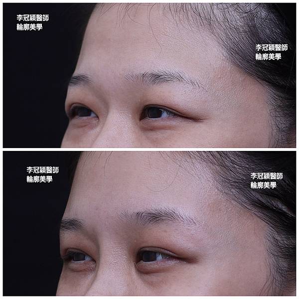 凹缺太陽穴和眉骨（眉弓）為什麼容易提早有下垂眼尾？如何治療？