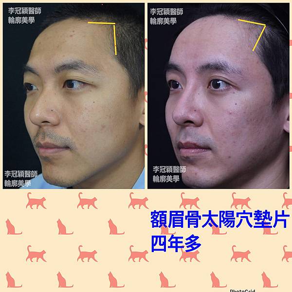 墊額頭『順便』拉頭皮但是留下大疤痕... 難接受😔😔😔。如果