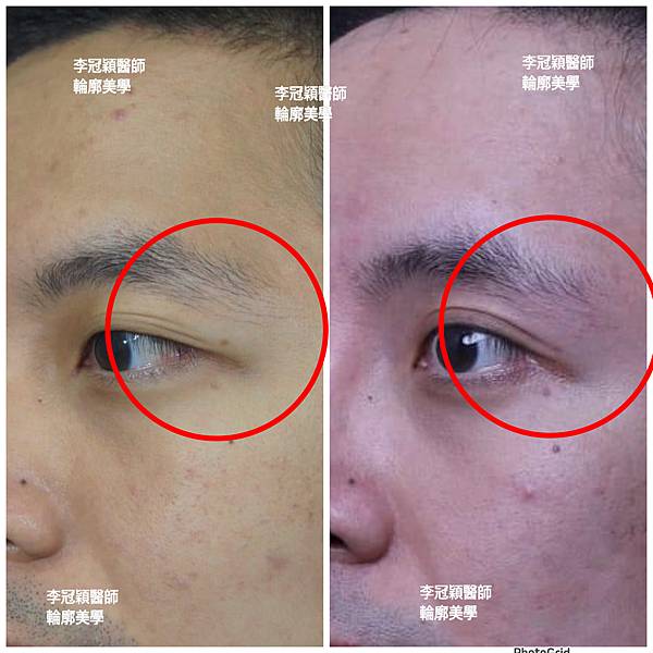 凹缺太陽穴和眉骨（眉弓）為什麼容易提早有下垂眼尾？如何治療？