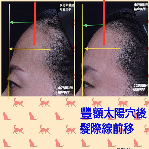 墊額頭『順便』拉頭皮但是留下大疤痕... 難接受😔😔😔。如果