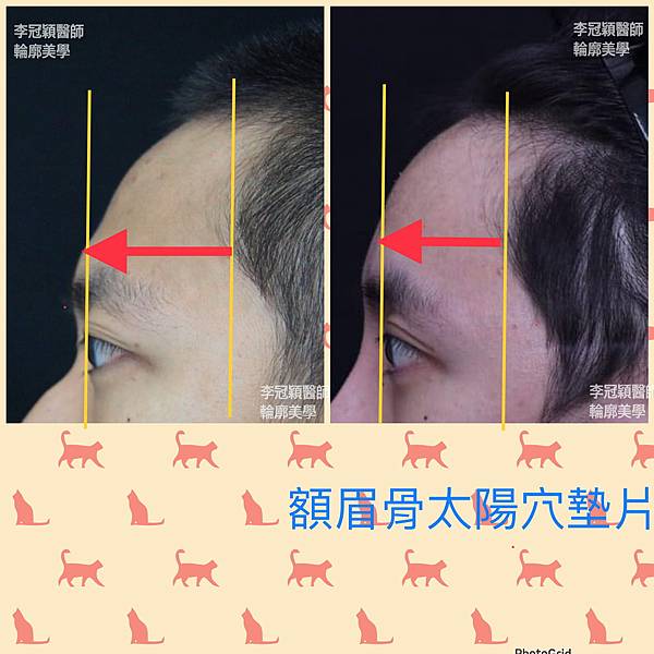 墊額頭『順便』拉頭皮但是留下大疤痕... 難接受😔😔😔。如果