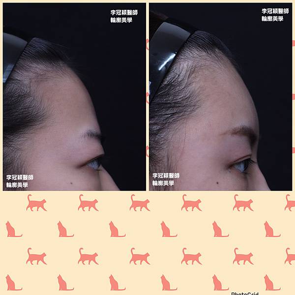 墊額頭『順便』拉頭皮但是留下大疤痕... 難接受😔😔😔。如果