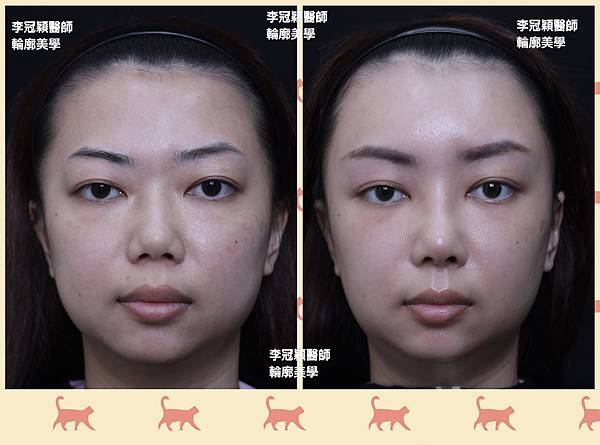 墊額頭『順便』拉頭皮但是留下大疤痕... 難接受😔😔😔。如果