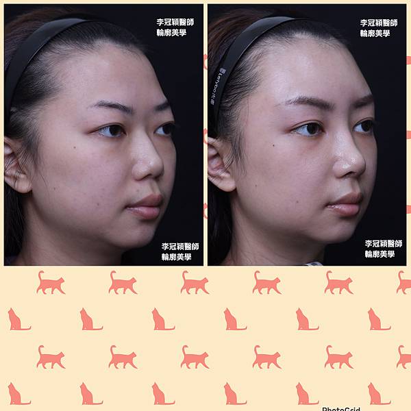 墊額頭『順便』拉頭皮但是留下大疤痕... 難接受😔😔😔。如果