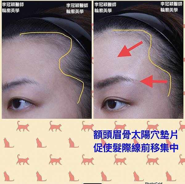 墊額頭『順便』拉頭皮但是留下大疤痕... 難接受😔😔😔。如果