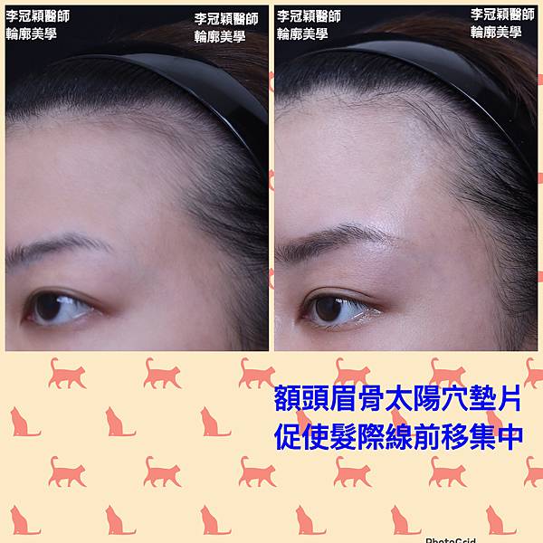 凹缺太陽穴和眉骨（眉弓）為什麼容易提早有下垂眼尾？如何治療？