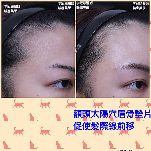 凹缺太陽穴和眉骨（眉弓）為什麼容易提早有下垂眼尾？如何治療？