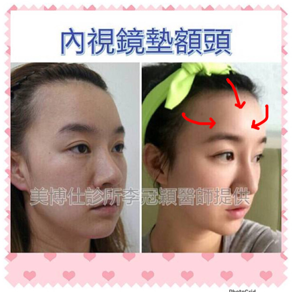 墊額頭『順便』拉頭皮但是留下大疤痕... 難接受😔😔😔。如果