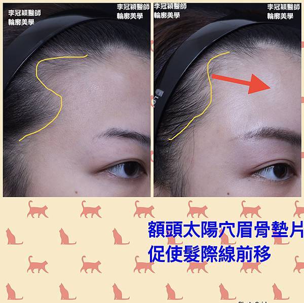 墊額頭『順便』拉頭皮但是留下大疤痕... 難接受😔😔😔。如果