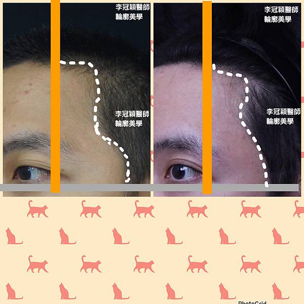 墊額頭『順便』拉頭皮但是留下大疤痕... 難接受😔😔😔。如果