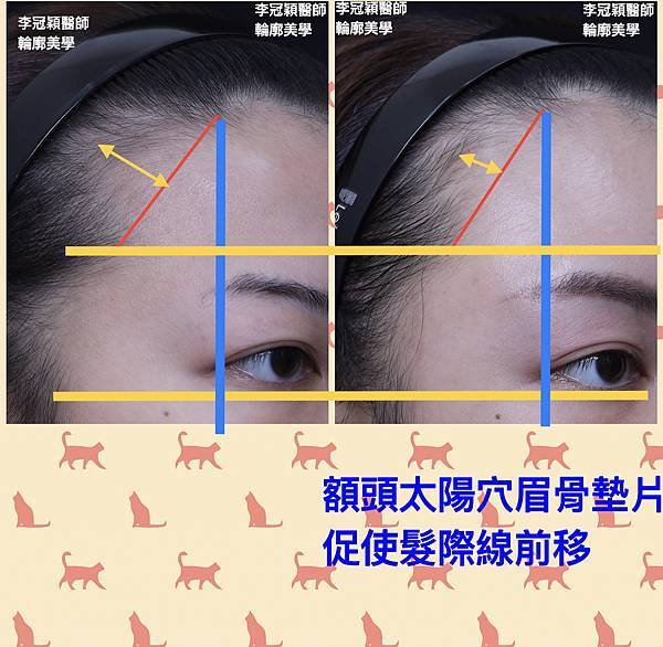 墊額頭『順便』拉頭皮但是留下大疤痕... 難接受😔😔😔。如果