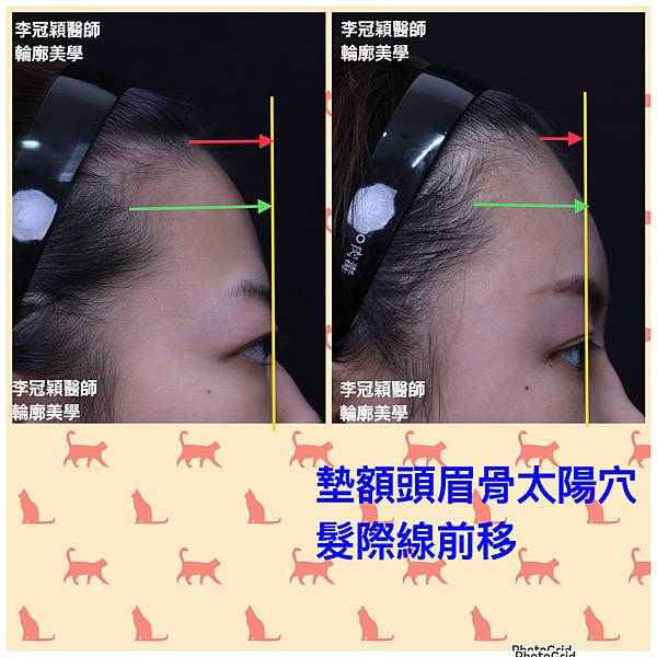 墊額頭『順便』拉頭皮但是留下大疤痕... 難接受😔😔😔。如果