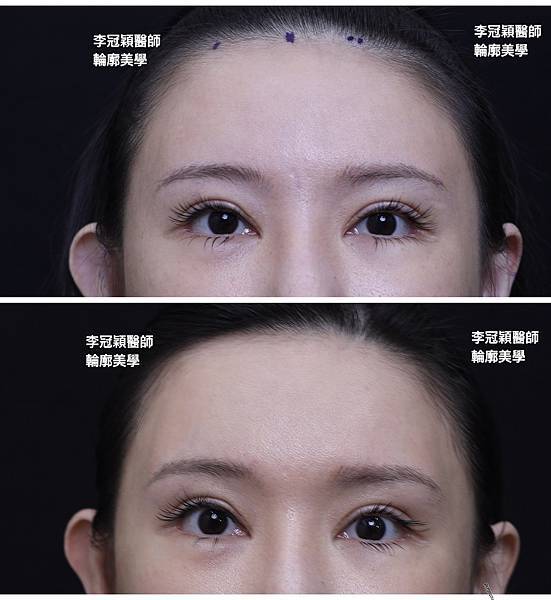 墊額頭『順便』拉頭皮但是留下大疤痕... 難接受😔😔😔。如果