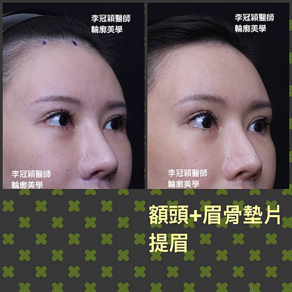 墊額頭『順便』拉頭皮但是留下大疤痕... 難接受😔😔😔。如果