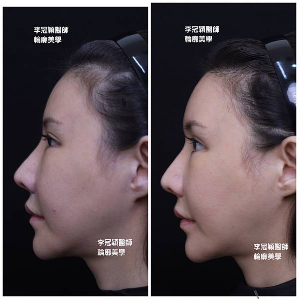 墊額頭『順便』拉頭皮但是留下大疤痕... 難接受😔😔😔。如果