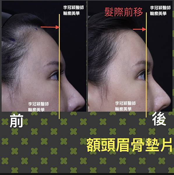 免切頭皮的豐額手術，效果如何？