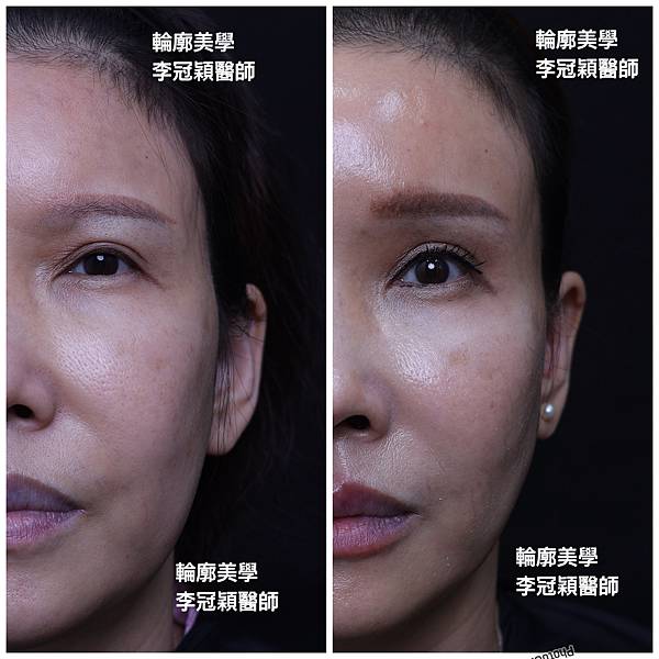 注射填充蘋果肌與墊片蘋果肌，哪個造成後續下垂？