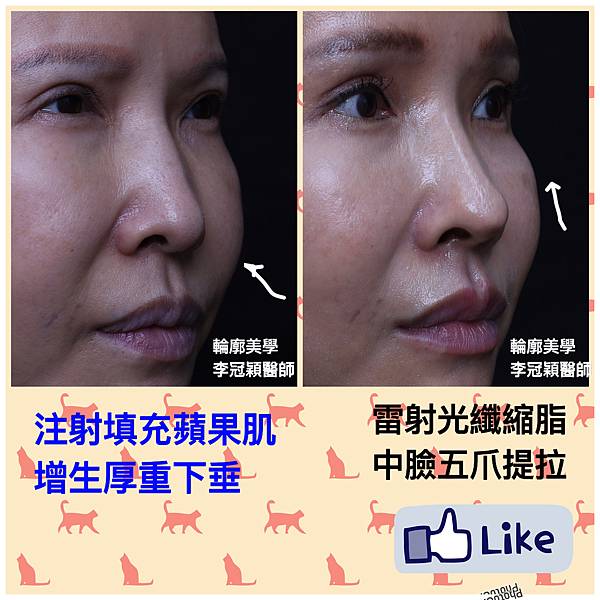 注射填充蘋果肌與墊片蘋果肌，哪個造成後續下垂？