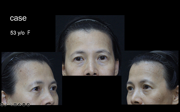 凹缺太陽穴和眉骨（眉弓）為什麼容易提早有下垂眼尾？如何治療？