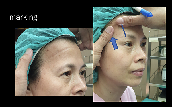 凹缺太陽穴和眉骨（眉弓）為什麼容易提早有下垂眼尾？如何治療？