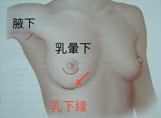 什麼是乳下緣入口隆乳
