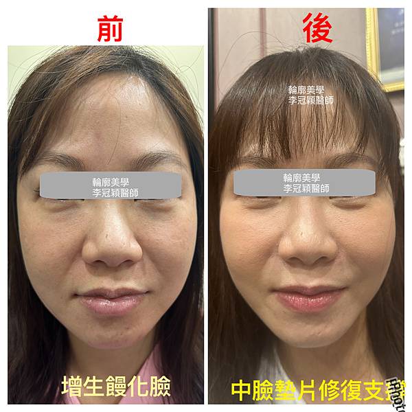 饅化老態經矯正改善