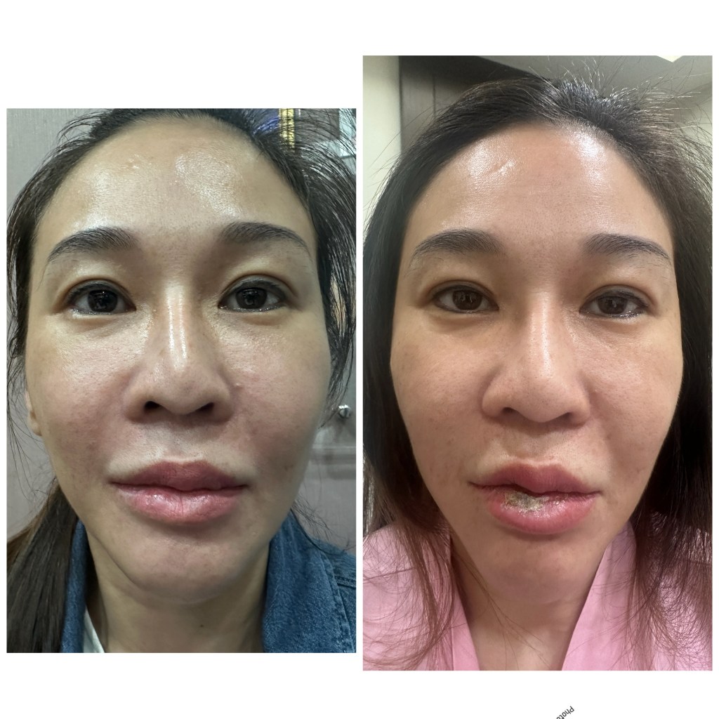 第一次溶解出現皮肉分離，