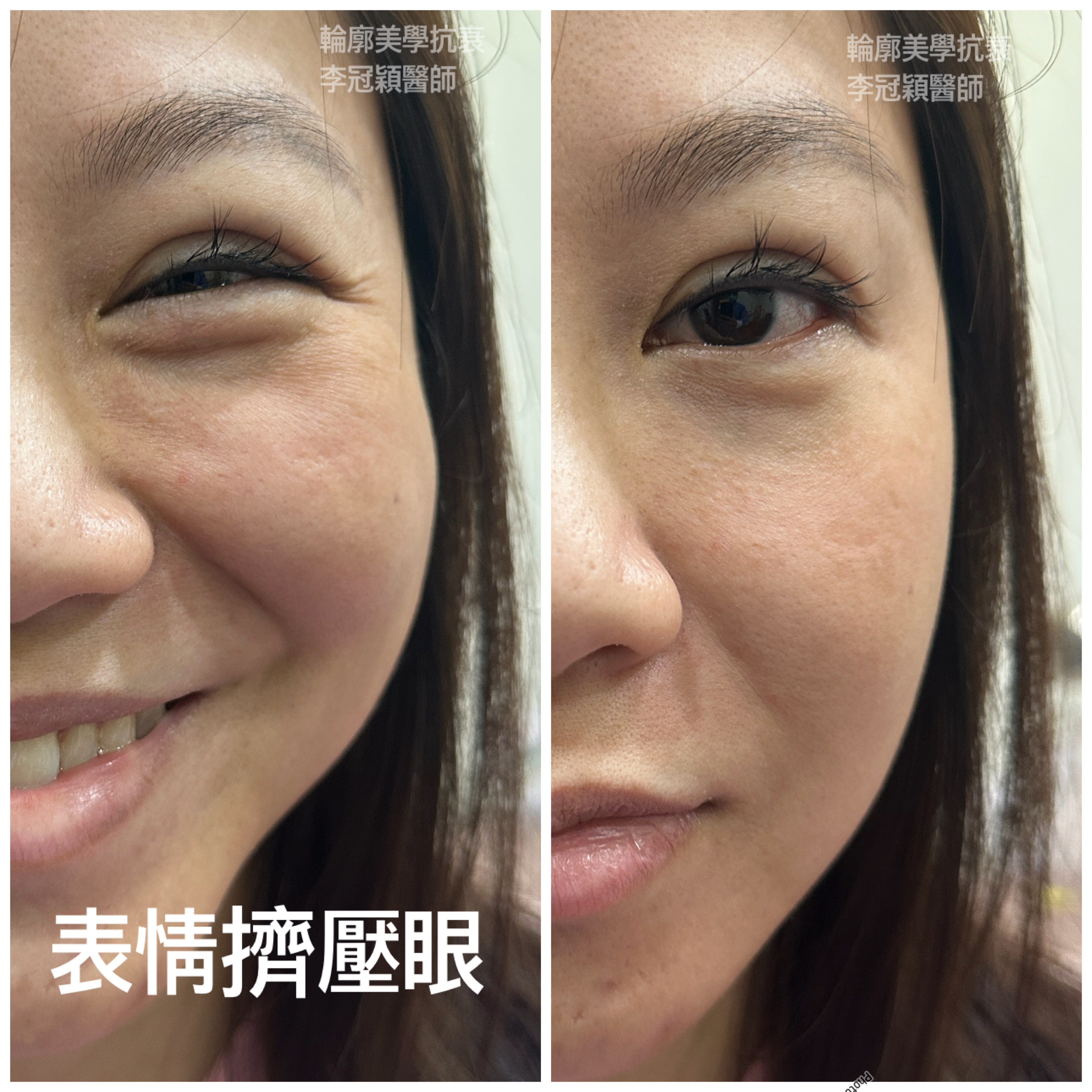 饅化表情擠壓眼型（sunset eye)