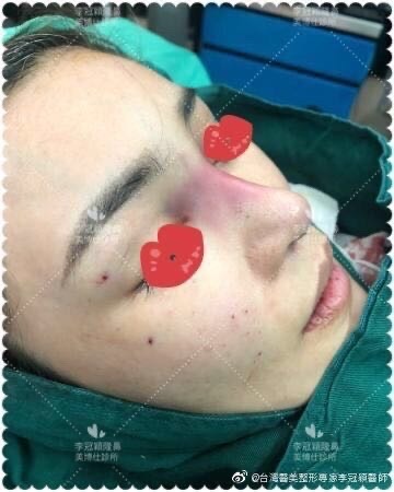 李冠穎醫師:什麼是Y型鼻(Y眉心)?隆鼻都須要墊眉心嗎?Y眉 李冠穎醫師:什麼是Y型鼻(Y眉心)?隆鼻都須要墊眉心嗎?Y眉