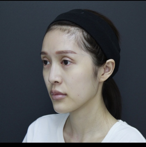 李冠穎醫師:什麼是Y型鼻(Y眉心)?隆鼻都須要墊眉心嗎?Y眉 fullsizeoutput_1da.jpeg - 鼻整形