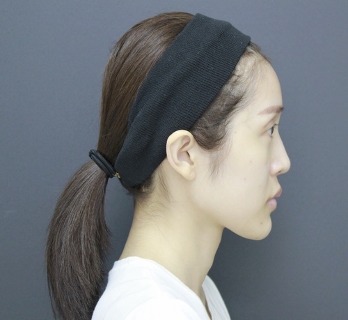 李冠穎醫師:什麼是Y型鼻(Y眉心)?隆鼻都須要墊眉心嗎?Y眉 fullsizeoutput_1dc.jpeg - 鼻整形