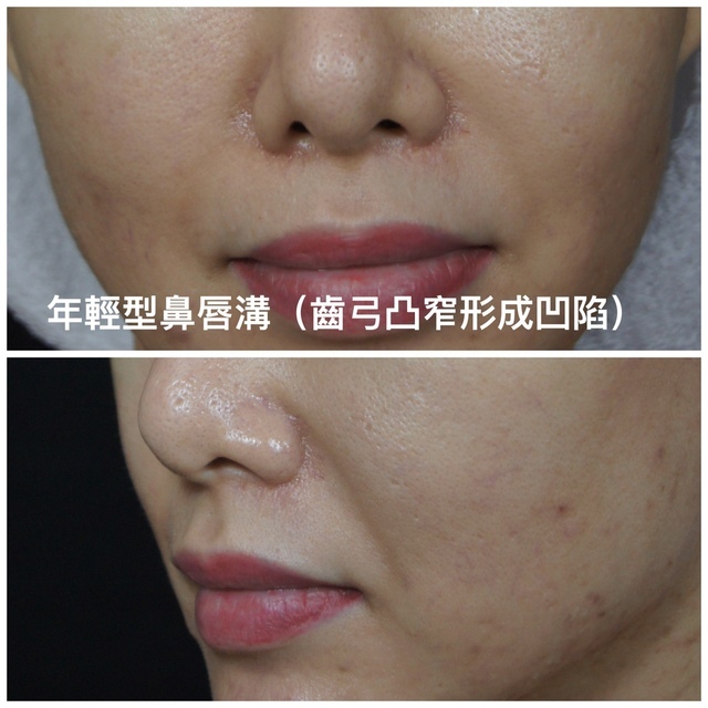 法令紋治療的盲點與正確方法