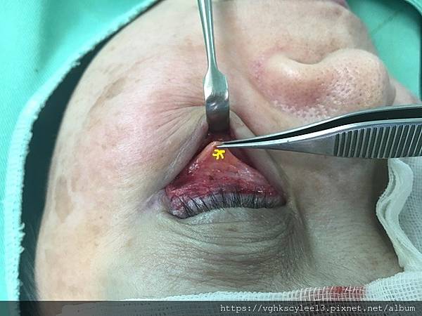 眼袋內開的方式（無痕眼袋）：年輕型眼袋