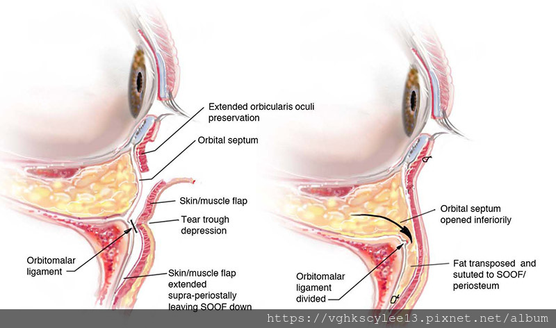 內開眼袋手術的優勢
