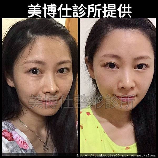 眼袋內開的方式（無痕眼袋）：年輕型眼袋