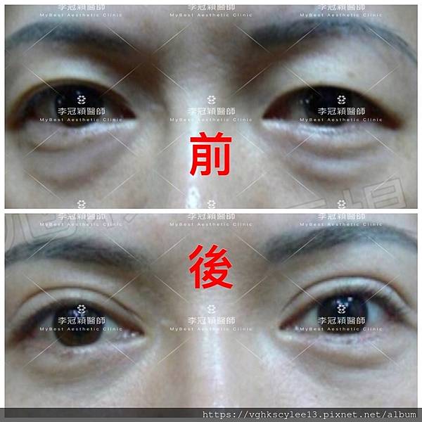 眼袋內開的方式（無痕眼袋）：年輕型眼袋