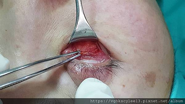 眼袋內開的方式（無痕眼袋）：年輕型眼袋