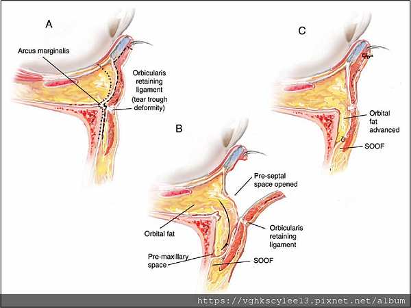 眼袋內開的方式（無痕眼袋）：年輕型眼袋