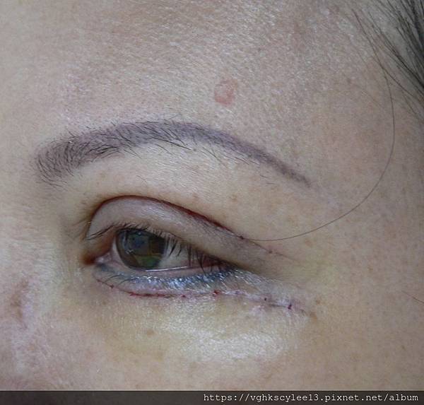 眼袋內開的方式（無痕眼袋）：年輕型眼袋