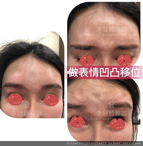 豐額頭或改善額型的方式有那些?它們的優缺點妳明白嗎? 豐額頭或改善額型的方式有那些?它們的優缺點妳明白嗎?