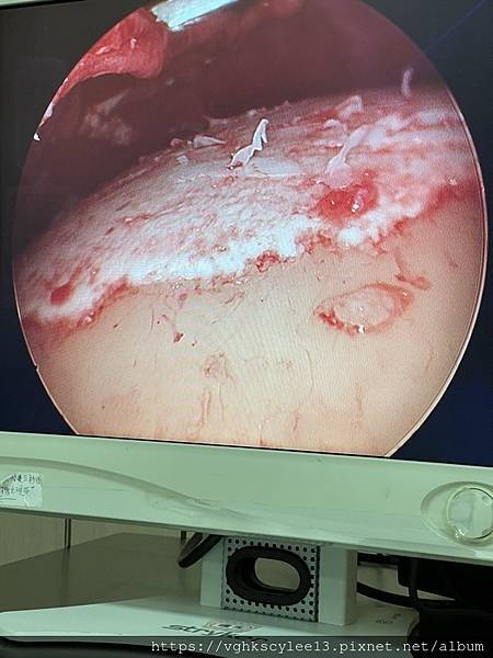 豐額頭或改善額型的方式有那些?它們的優缺點妳明白嗎? 豐額頭或改善額型的方式有那些?它們的優缺點妳明白嗎?