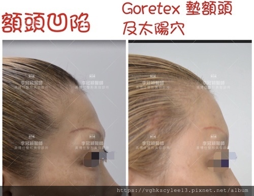 豐額頭或改善額型的方式有那些?它們的優缺點妳明白嗎? 豐額頭或改善額型的方式有那些?它們的優缺點妳明白嗎?