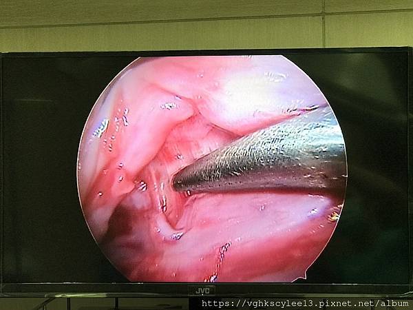 豐額頭或改善額型的方式有那些?它們的優缺點妳明白嗎? 豐額頭或改善額型的方式有那些?它們的優缺點妳明白嗎?