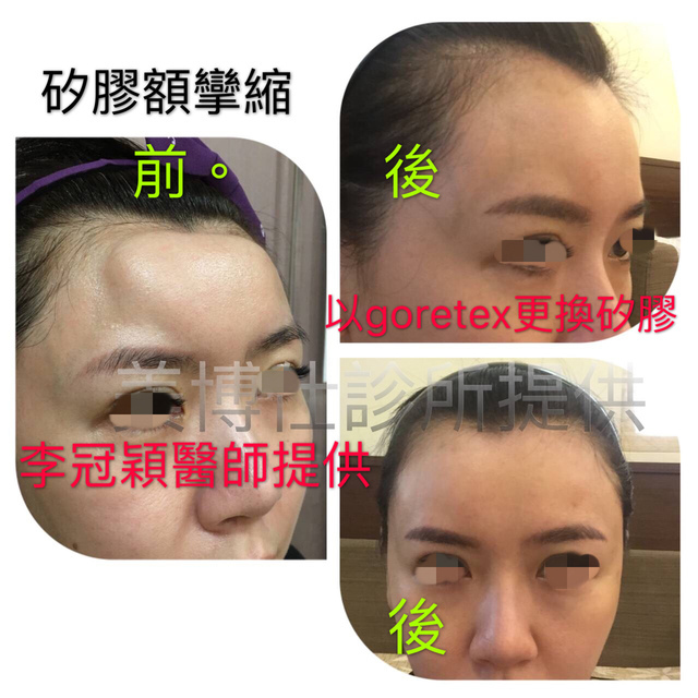 豐額頭手術：材質與技術的選擇