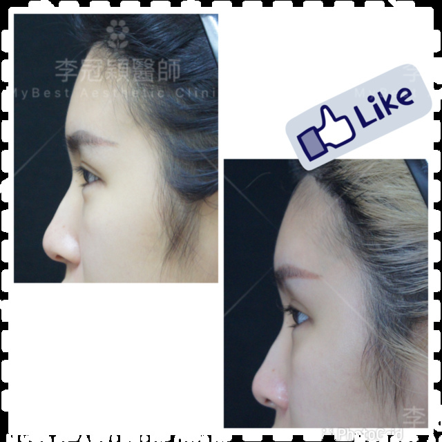 豐額頭或改善額型的方式有那些?它們的優缺點妳明白嗎? 豐額頭或改善額型的方式有那些?它們的優缺點妳明白嗎?