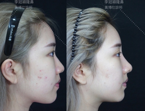 李冠穎醫師:什麼是Y型鼻(Y眉心)?隆鼻都須要墊眉心嗎?Y眉 IMG_7357.JPG - 鼻整形