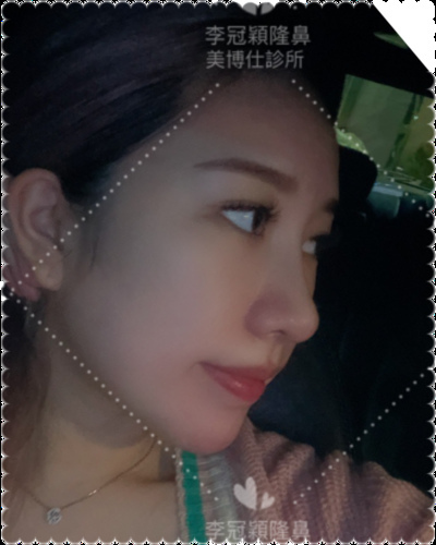 李冠穎醫師:什麼是Y型鼻(Y眉心)?隆鼻都須要墊眉心嗎?Y眉 IMG_7808.PNG - 鼻整形