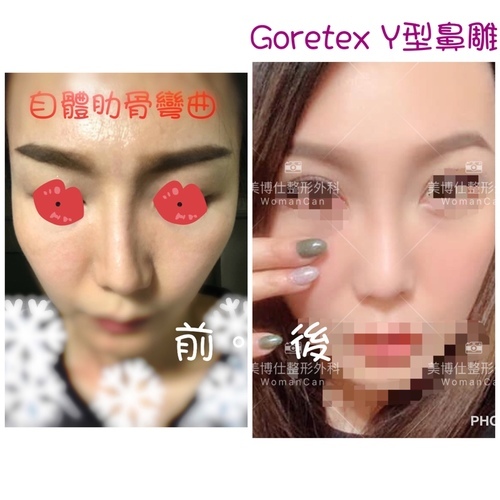 李冠穎醫師:什麼是Y型鼻(Y眉心)?隆鼻都須要墊眉心嗎?Y眉 IMG_1420.JPG - 鼻整形