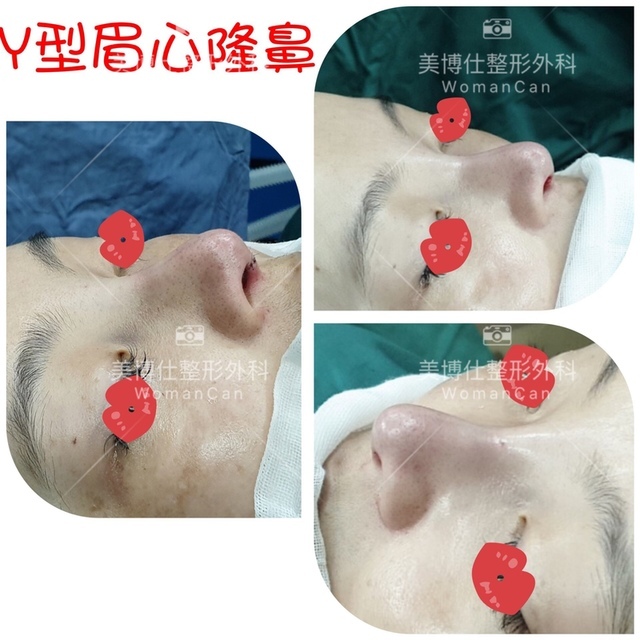 李冠穎醫師:什麼是Y型鼻(Y眉心)?隆鼻都須要墊眉心嗎?Y眉 李冠穎醫師:什麼是Y型鼻(Y眉心)?隆鼻都須要墊眉心嗎?Y眉